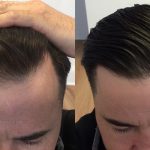 Cost of Hair Transplant in London