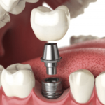 Dental Implants Abroad