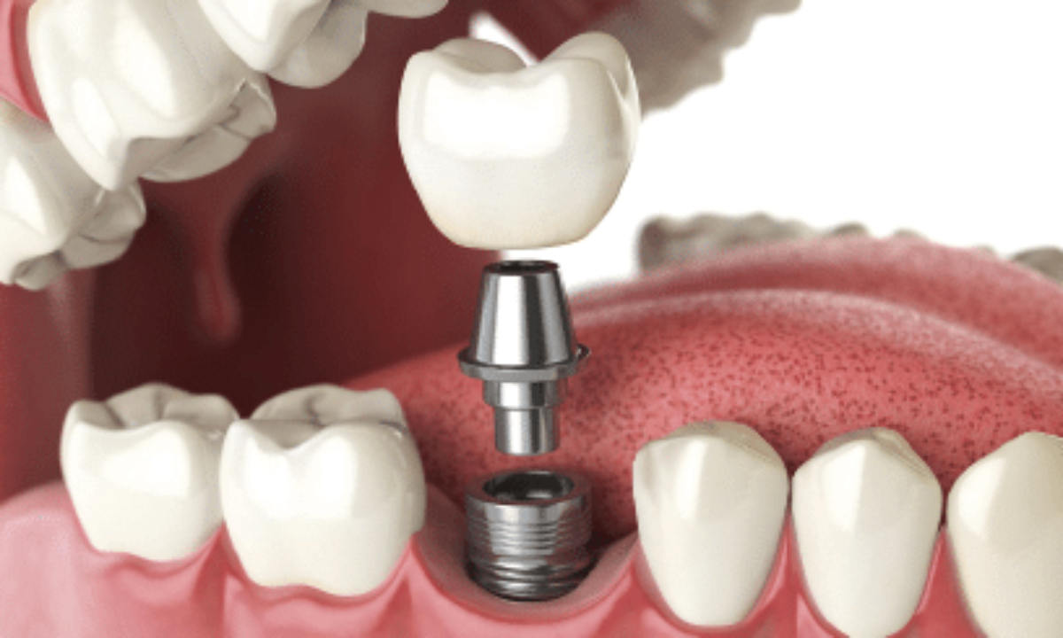 The Truth About Dental Implants Abroad