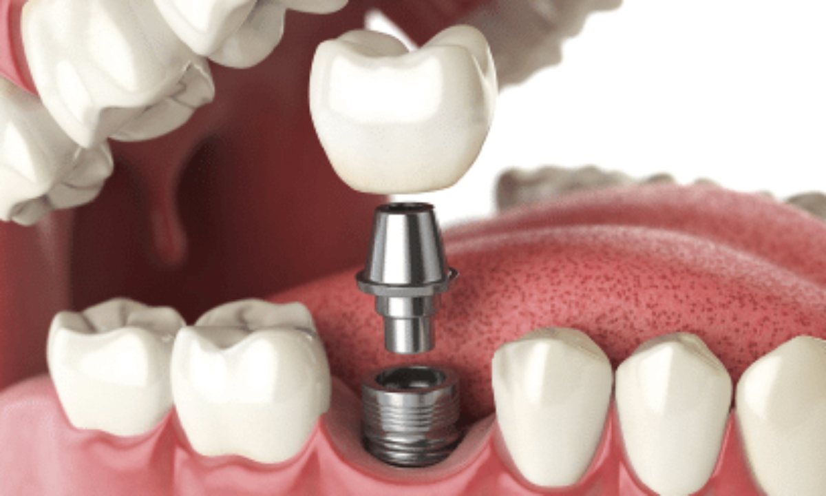 Dental Implants Abroad